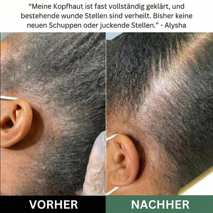 LISSIMA Natürliches Kopfhautpeeling – bei schuppiger, juckender und gereizter Kopfhaut